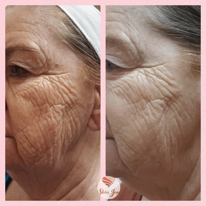 AMG Procell for sagging & wrinkling 3